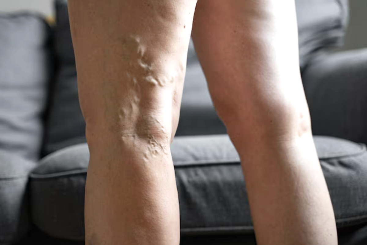 Křečové žíly trápí ženy i muže. Prevencí je žilní gymnastika