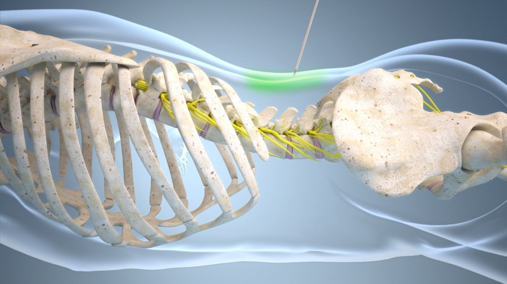 Intervenční léčbu bolesti zad 
nově hradí zdravotní pojišťovny