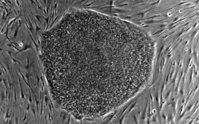 V Praze začali léčit artrózu
kmenovými buňkami
