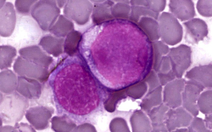 V Plzni zkouší unikátní
přípravek proti leukémii