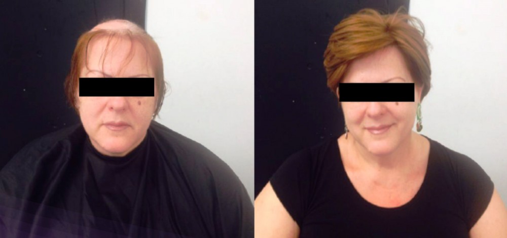 Vypadávání vlasů má nové
řešení. Levnější a šetrnější