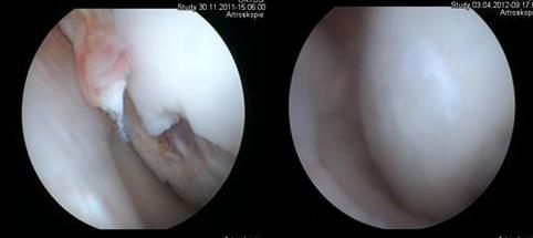 RenehaVis: novinka 
pro léčbu osteoartrózy