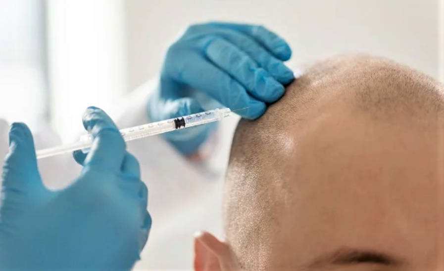 Chci mít opět vlasy. Tuzemský trh s transplantacemi zažívá boom